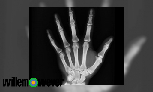 Hoe werkt een röntgenfoto?