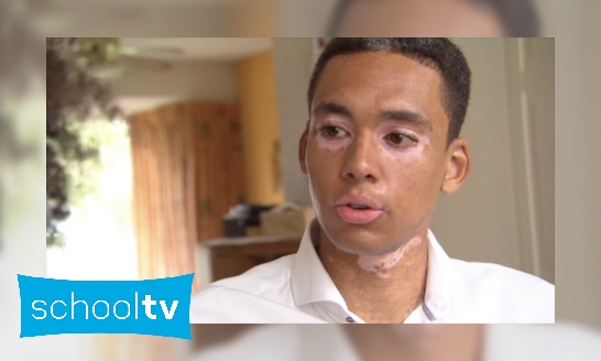 Plaatje Wat is Vitiligo?